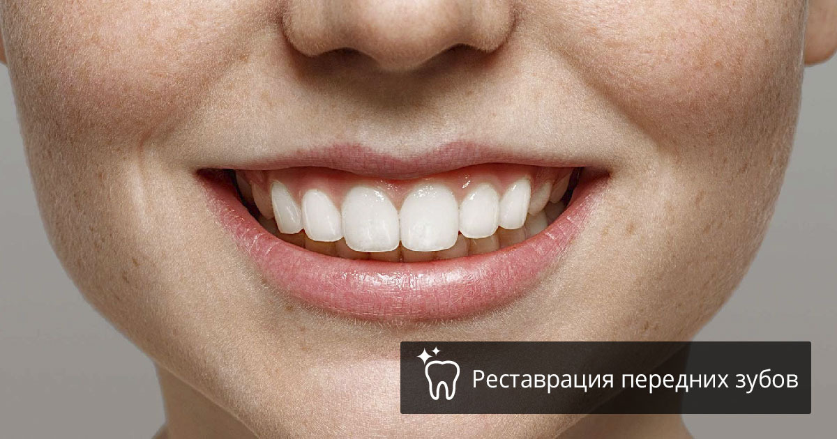 Реставрации передних зубов