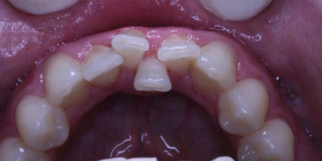 Удаление зубов до