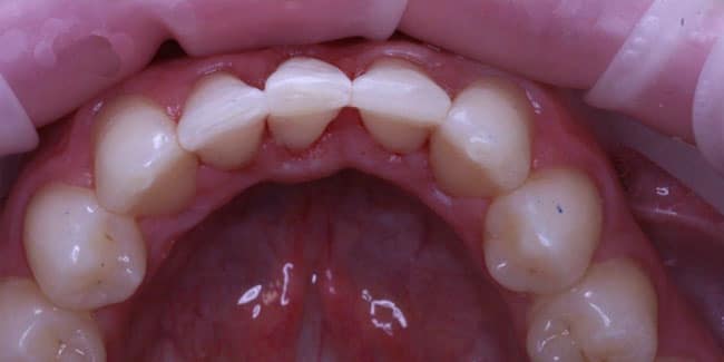 Удаление зубов после