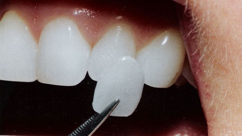Непрямая реставрация передних зубов винирами