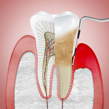 периодонтит зуба лечение