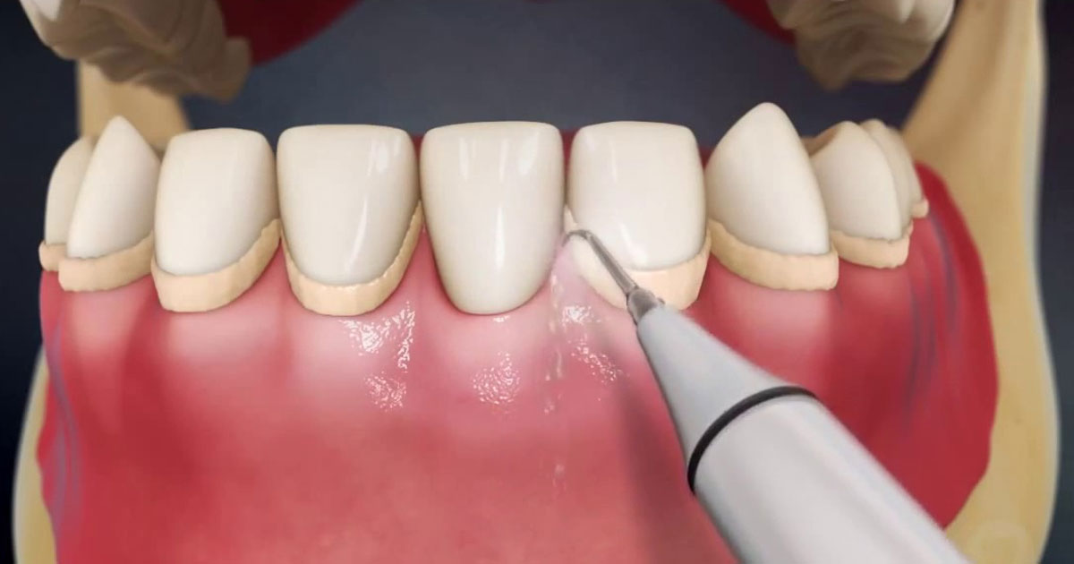 Акция на комплексную ультразвуковую чистку зубов