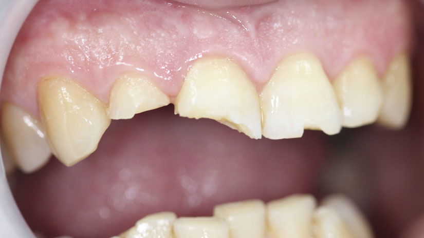 Что делать при повреждение передних зубов?