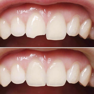 Реставрации передних зубов пломбой