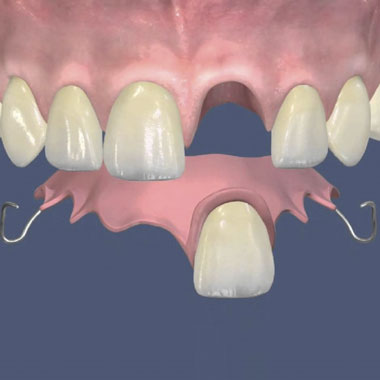 Установка съемного протеза на передний зуб