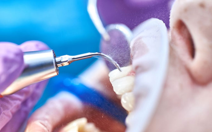 Лечение гингивита аппаратная чистка зубов