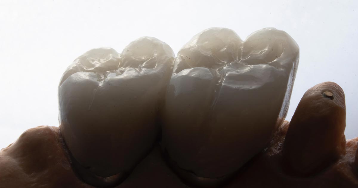 Имплантация двух зубов быстро не дорого