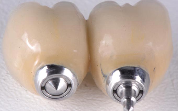 Имплантация верхних жевательных зубов