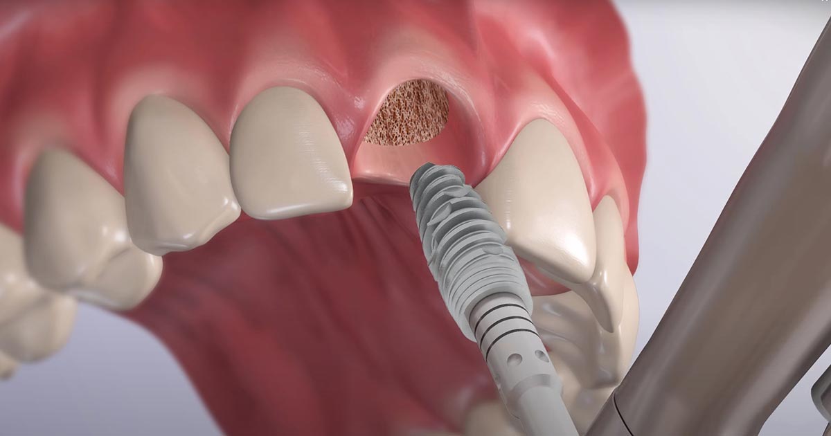 Имплантация передних зубов что это? как делается? сколько стоит?