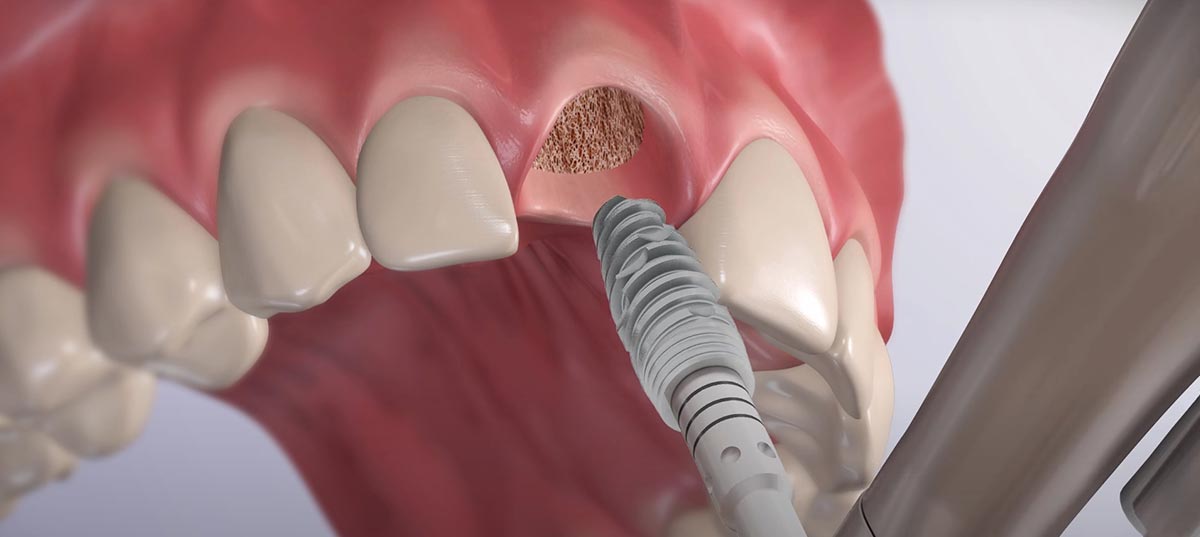 Особенности имплантации передних зубов | Семейная стоматология