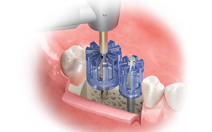 Этапы имплантации двух зубов рядом