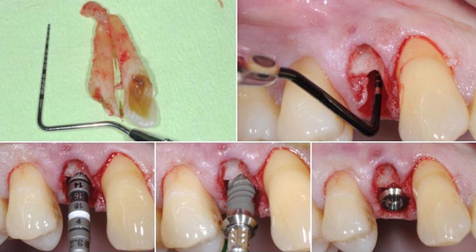 Этапы установки импланта зуба 2-й визит (вживление имплантата)