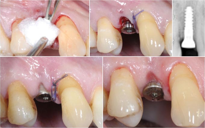 Какие этапы включает имплантация передних зубов?