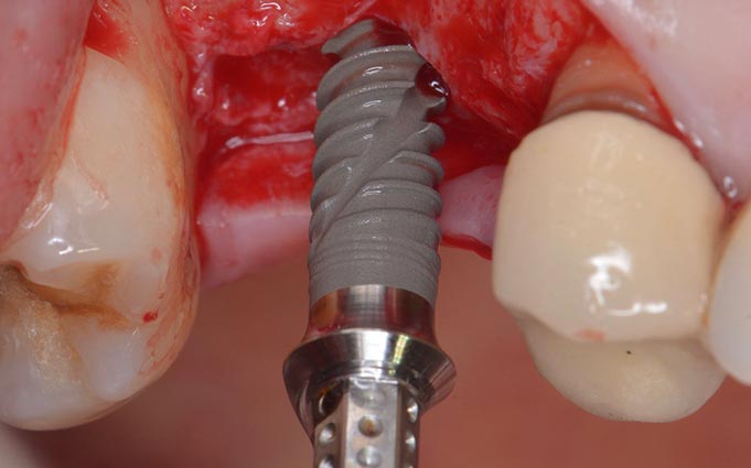 Основные характеристики имплантации передних зубов