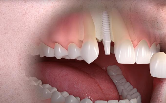 Способы имплантации передних зубов