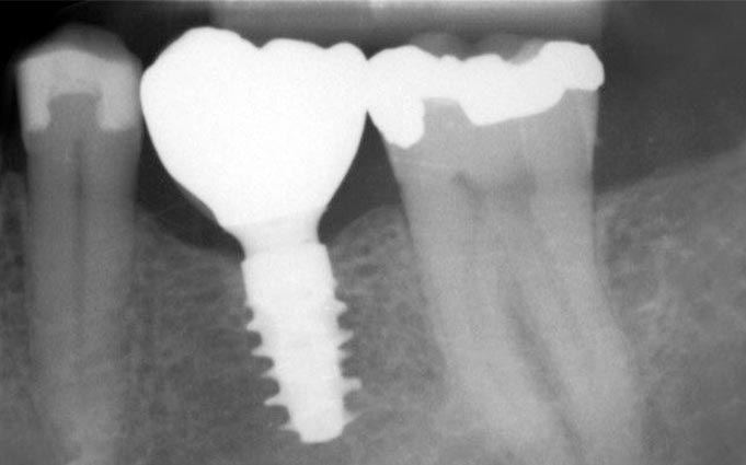 Какая имплантация зубов лучше: одномоментная или двухэтапная?