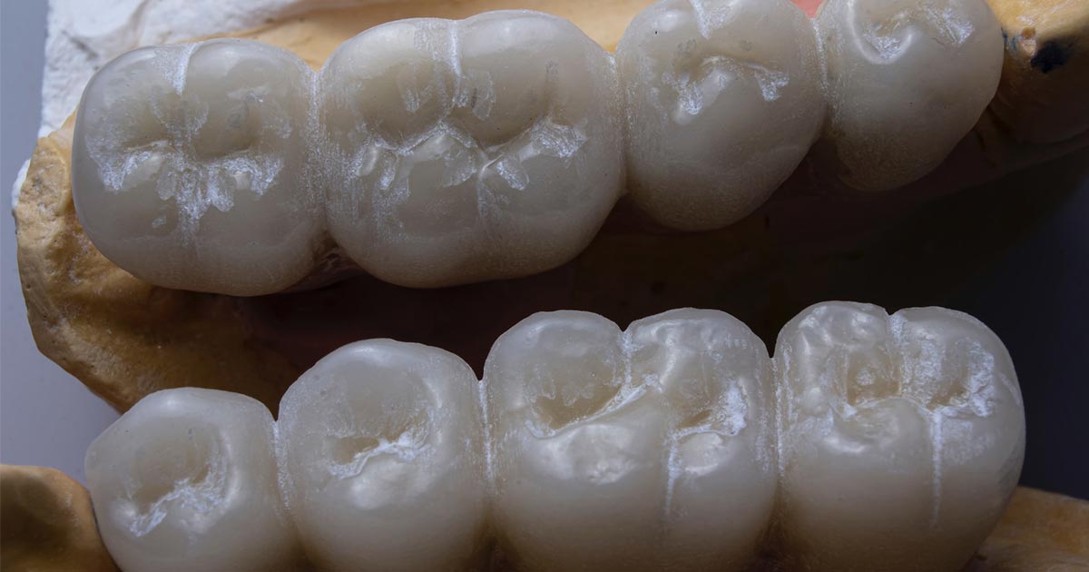 Какие коронки лучше ставить на жевательные зубы, а какие на передние?