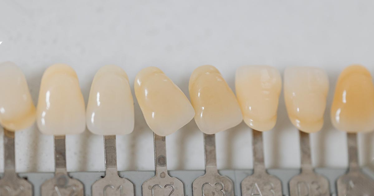 Какие коронки на передние зубы лучше ставить?