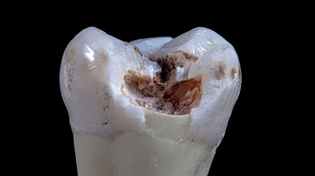 Какой бывает перелом зуба?