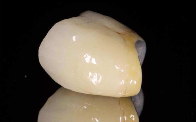 Керамическая коронка на зуб