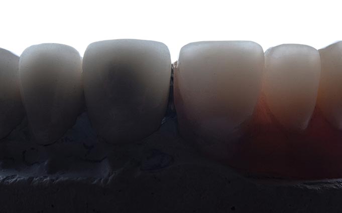 Керамические коронки на передние зубы