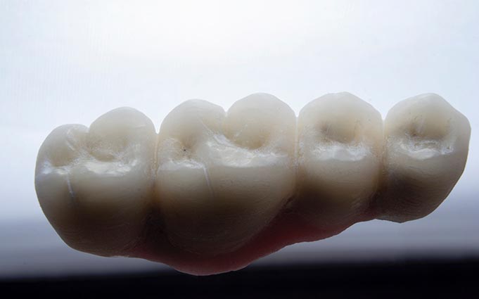 Коронки на зуб