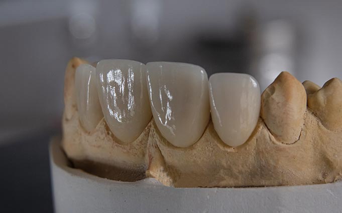 Циркониевые коронки на передние зубы