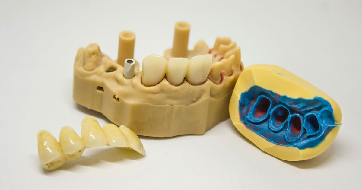 Мини-импланты зубов для фиксации съемных протезов — виды и цены