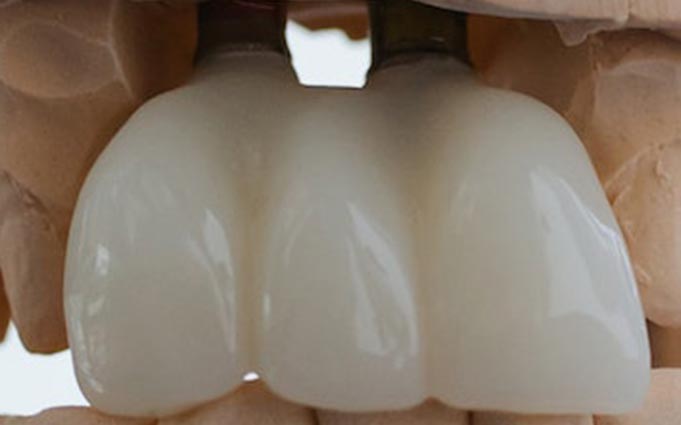 Общие характеристики моста на зубы