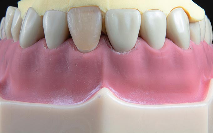 Съемное зубное протезирование