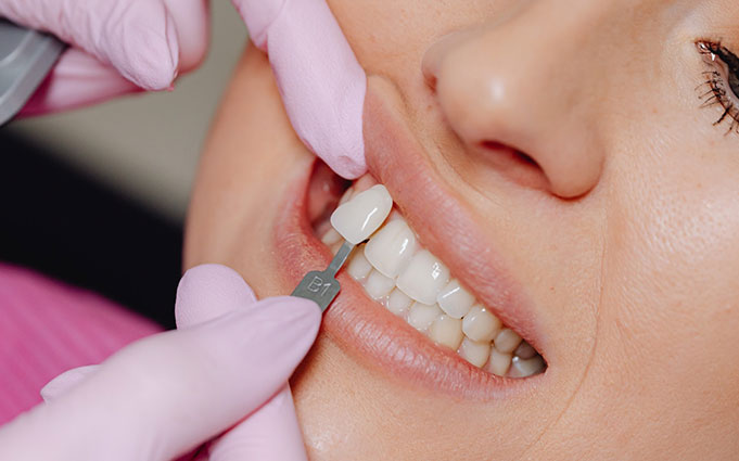 Способы реставрации зуба после скола в стоматологии