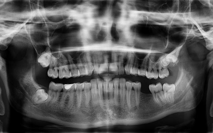 В каких случаях стоматологи рекомендуют сделать панорамный снимок зубов?