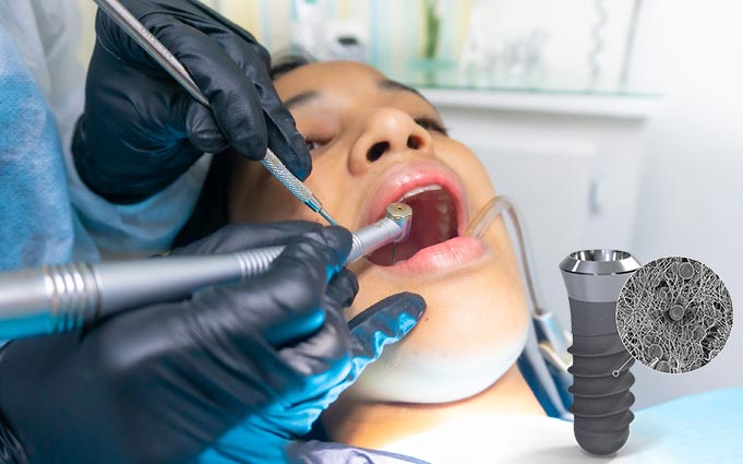 Возможна ли имплантация зубов за один день?