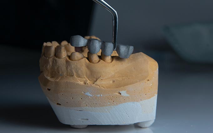 Временные коронки на зубы: пластмассовые протезы