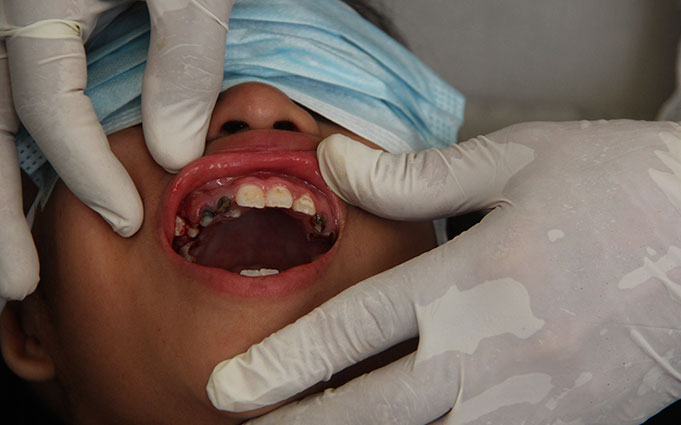 В каких случаях показано сложное удаление зуба?