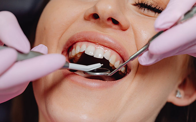 Как происходит шинирование зубов