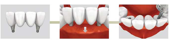 Как восстановить зубной ряд после удаления зуба?