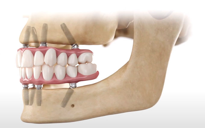 Имплантация при полном отсутствии зубов