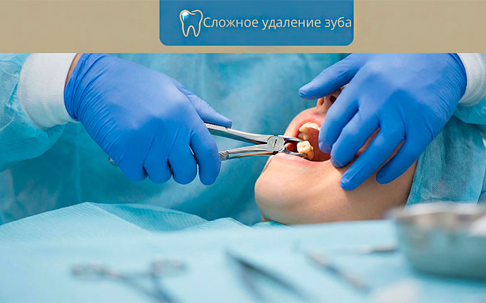 Особенности сложного удаления зубов на нижней челюсти